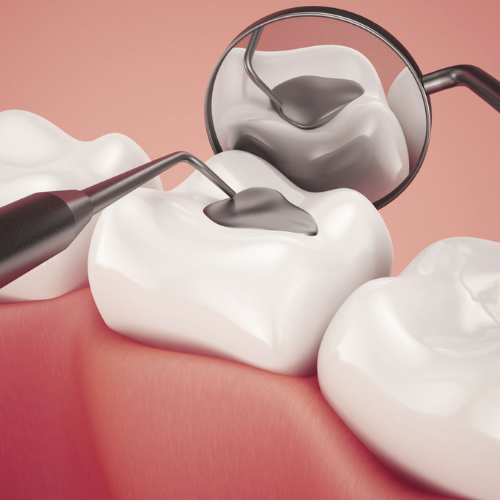 Dental Fillings vs. Inlays and Onlays