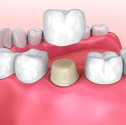 Dental Crowns